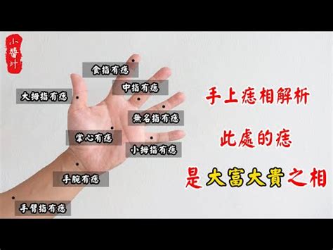 左手胎記|胎記位置含義——肚臍、鎖骨、手臂、大腿、背部、胳膊、額頭。